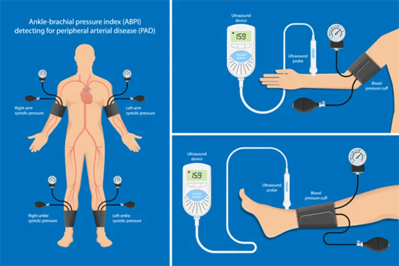 แผลเบาหวานติดเชื้อง่าย หายยาก รักษาหลอดเลือดตีบ ก่อนลุกลามถูกตัดเท้า