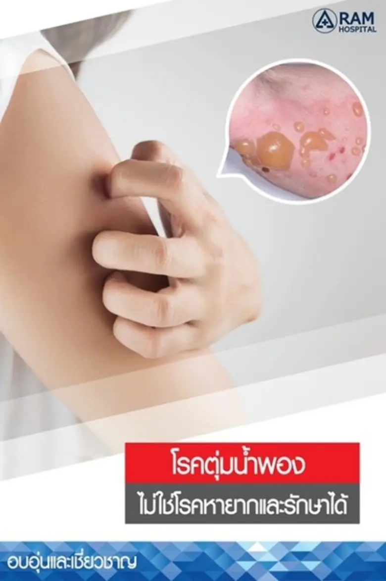 โรคตุ่มน้ำพองเกิดจากภูมิคุ้มกันของร่างกาย...