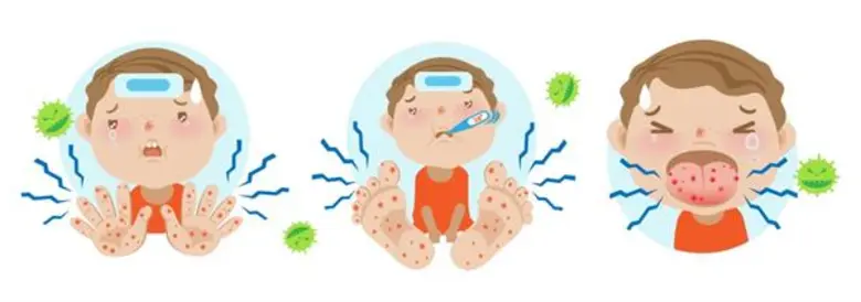 รู้ทันโรค มือ เท้า ปาก โรคใกล้ตัวเด็กวัยเรียน