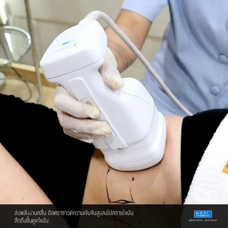 คุณเคยได้ยินไหมว่า "เอาไขมันออกจากร่างกาย" ทำได้แบบไม่ต้องผ่าตัดให้เจ็บตัว