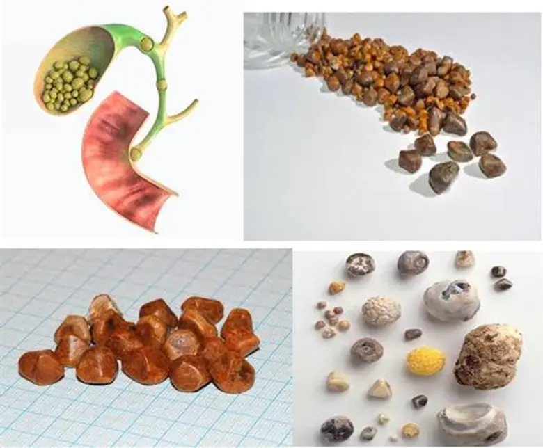 นิ่วในถุงน้ำดีหรือ (Gallstone) เป็นโรคที่...