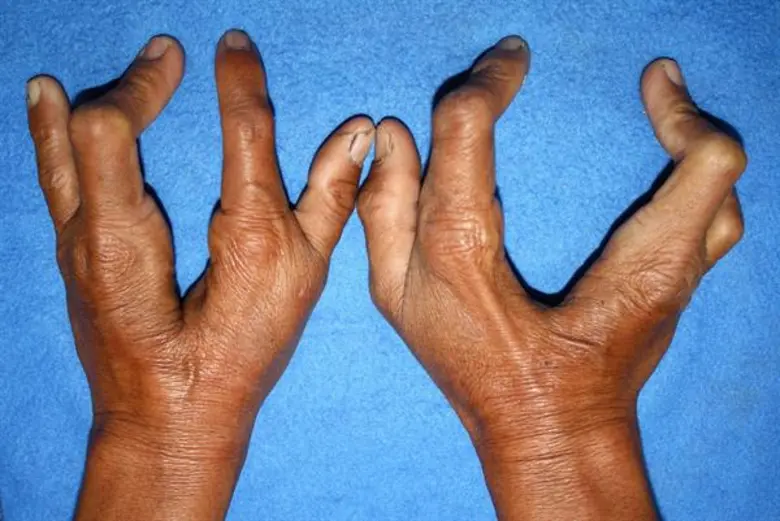 โรคหายาก ความท้าทาย ที่ต้องเร่งวินิจฉัย