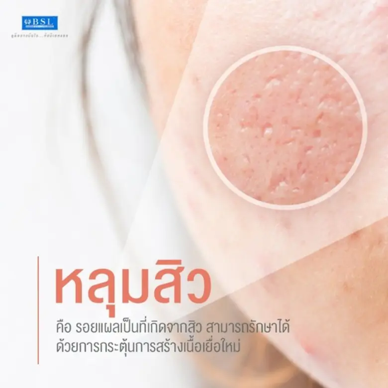 หลุมสิว เกิดจากอะไร แผลเป็นหลุมสิว เกิดจา...