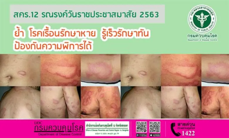 สคร.12 รณรงค์วันราชประชาสมาสัย 2563 ย้ำ โรคเรื้อนรักษาหาย รู้เร็วรักษาทัน ป้องกันความพิการได้