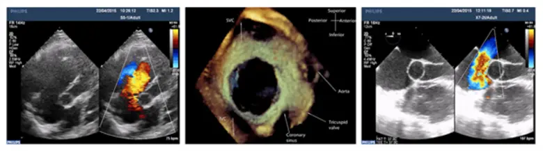 พาคนที่คุณรัก ทะนุถนอมหัวใจ ตรวจเช็ก 4 อาการผนังกั้นหัวใจห้องบนรั่วแต่กำเนิด