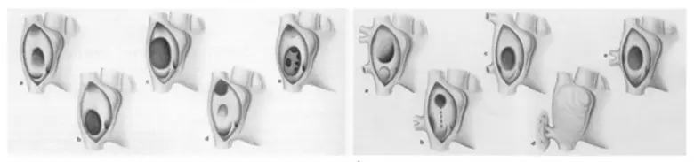 พาคนที่คุณรัก ทะนุถนอมหัวใจ ตรวจเช็ก 4 อาการผนังกั้นหัวใจห้องบนรั่วแต่กำเนิด
