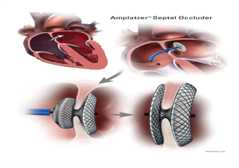 พาคนที่คุณรัก ทะนุถนอมหัวใจ ตรวจเช็ก 4 อาการผนังกั้นหัวใจห้องบนรั่วแต่กำเนิด
