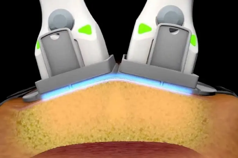 ความร้อน VS ความเย็น วิธีไหนฆ่าไขมันตายเกลี้ยงได้ดีกว่ากัน