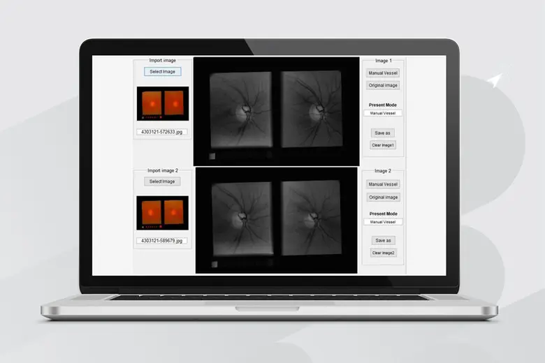 วิศวะฯ ธรรมศาสตร์ โชว์เจ๋ง “ผู้ช่วยแพทย์คัดกรองต้อหิน”  “รู้เร็ว รักษาเร็ว” ลดความเสี่ยงตาบอดสนิท !