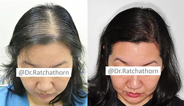 ผมบางศีรษะล้านจากพันธุกรรม