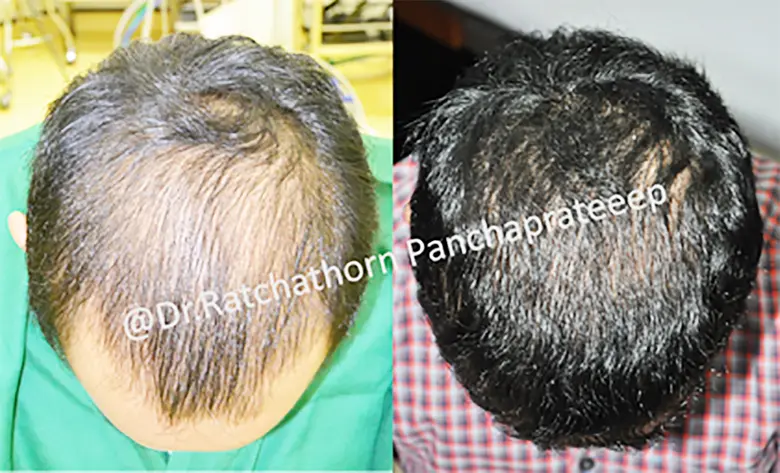 ผมบางศีรษะล้านจากพันธุกรรม