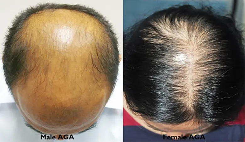 ผมบางศีรษะล้านจากพันธุกรรม