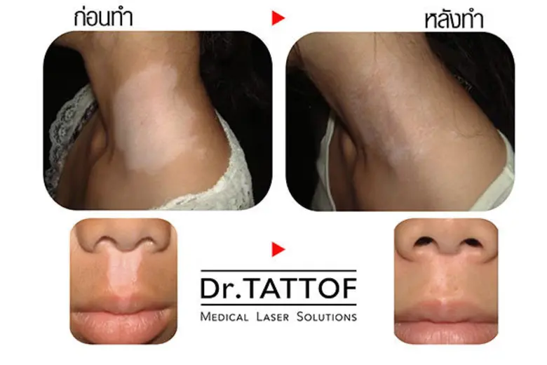 โรคด่างขาว อุปสรรคของความสวยงาม ที่ถึงแม้...