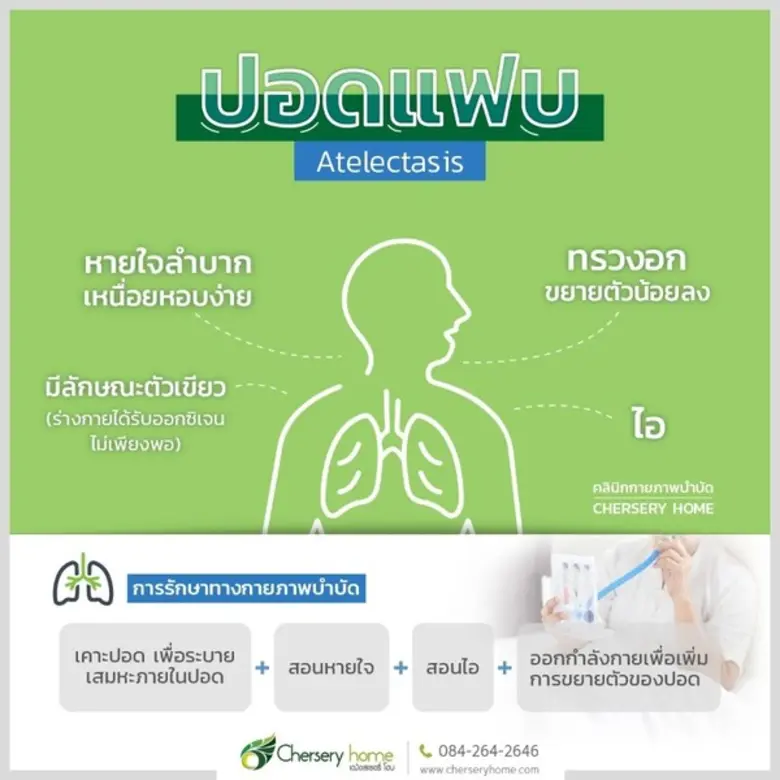 ปอดแฟบ (Atelectasis) เป็นภาวะที่ปอดขยายตั...