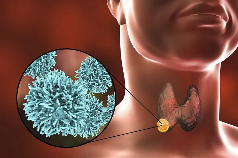 รู้ทันมะเร็งต่อมไทรอยด์ก่อนลุกลาม