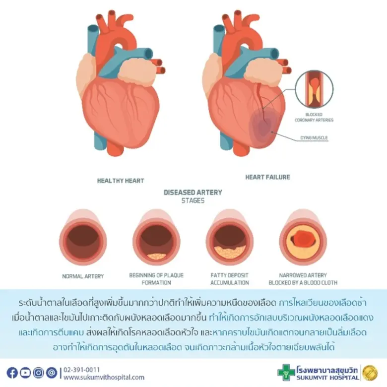 โรคเบาหวานเสี่ยงโรคหลอดเลือดหัวใจ (Cardio...
