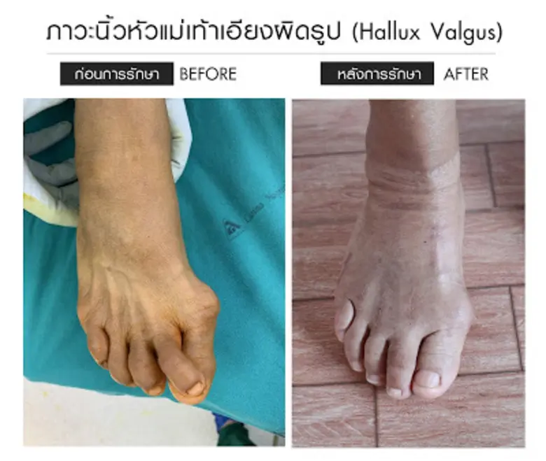 "นิ้วเท้าเอียงผิดรูป" ปัญหาที่สร้างความเจ็บปวดให้มาเนิ่นนาน รพ.ลานนา จัดแพทย์เฉพาะทางด้านข้อเท้า พร้อมรักษาได้ถึงขั้น "ผ่าตัด"