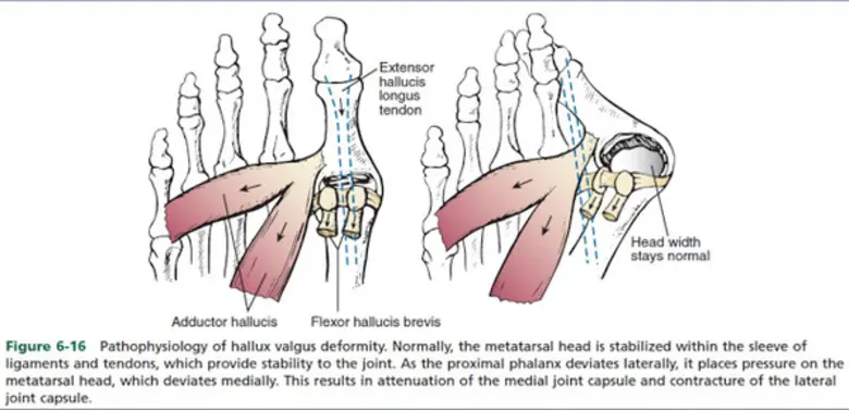 "นิ้วเท้าเอียงผิดรูป" ปัญหาที่สร้างความเจ็บปวดให้มาเนิ่นนาน รพ.ลานนา จัดแพทย์เฉพาะทางด้านข้อเท้า พร้อมรักษาได้ถึงขั้น "ผ่าตัด"