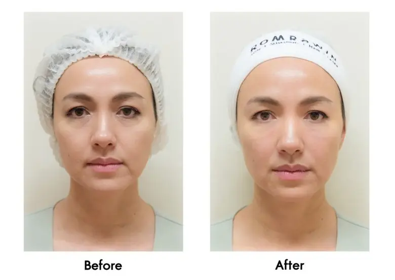 เชื่อหมอ! รอยหมองคล้ำรอบดวงตาเริ่มมาเยือนตั้งแต่วัย 20 ต้นๆ รีบพบแพทย์เพื่อชะลอก่อนเกิดริ้วรอยก่อนวัยอันควร