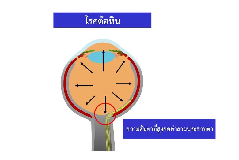 คณะแพทยศาสตร์ศิริราชพยาบาลแนะตรวจ "ต้อหิน" ปีละ 1 ครั้ง ชี้รู้เร็วรักษาได้ป้องกันไม่ให้ตาบอด
