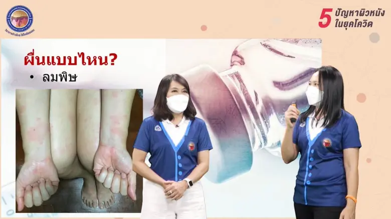 โรคโควิด-19 กับอาการทางผิวหนังที่ไม่ควรมองข้าม (ตอนที่ 2)