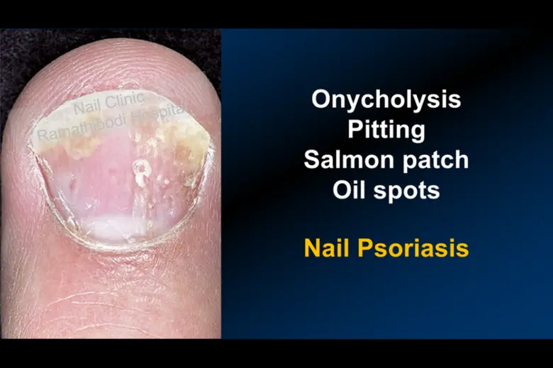 โรคสะเก็ดเงินที่เล็บ