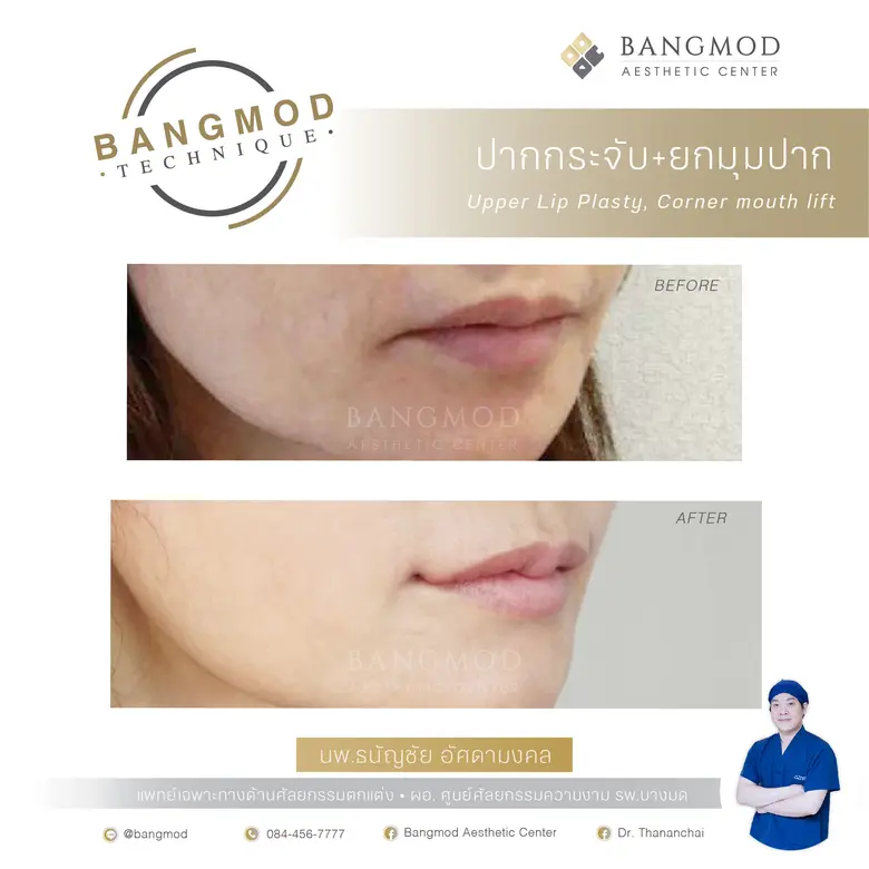 รู้ให้รอบก่อนทำ ศัลยกรรมปาก ศูนย์ศัลยกรรมความงาม รพ.บางมด