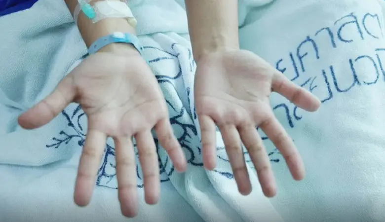 เหงื่อออกมือไม่ใช่สัญญาณของโรคหัวใจ