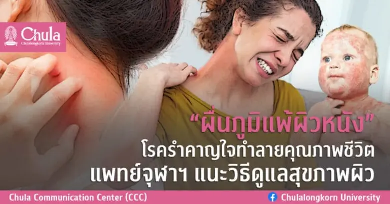 พบผู้ป่วยโรคผื่นภูมิแพ้ผิวหนังเพิ่มขึ้น แ...