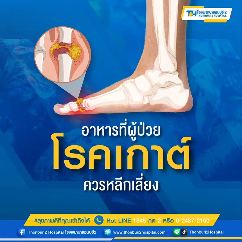 โรคเกาต์ เป็นโรคข้ออักเสบที่เกิดจากระดับก...