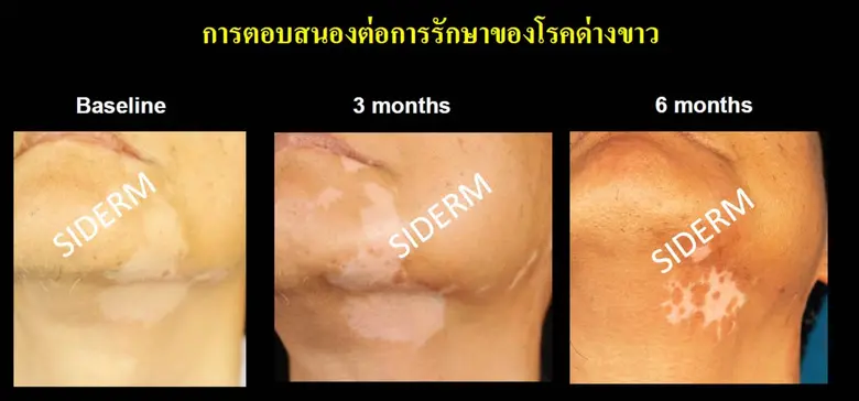 เรื่องน่ารู้เกี่ยวกับโรคด่างขาว