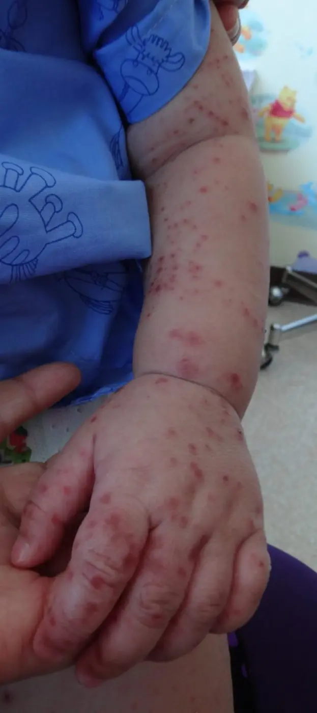 ติดตามสถานการณ์โรคมือเท้าปากในช่วงฤดูฝน