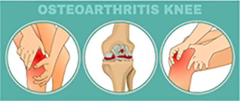 วิจัยพบสาร "ไซโตไคน์" บ่งชี้ "ข้อเสื่อม" แพทย์จุฬาฯ หวังช่วยวางแผนการรักษา ชะลอความรุนแรงของโรค