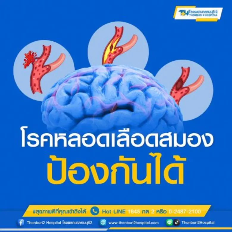 โรคหลอดเลือดสมองเป็นโรคที่มีอัตราการเสียช...