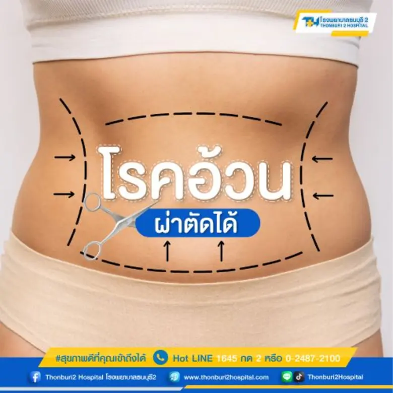 โรคอ้วน (Morbid obesity) คือภาวะที่ร่างกา...
