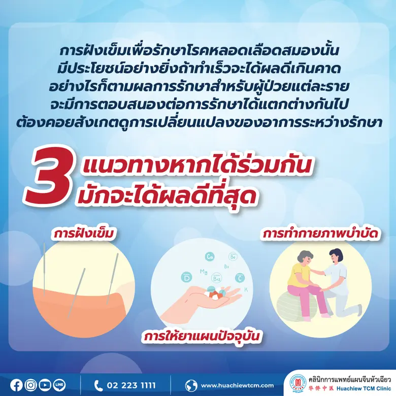 การฝังเข็ม ปลุกสมองเปิดทวาร รักษาโรคหลอดเลือดสมอง โดย คลินิกการแพทย์แผนจีนหัวเฉียว