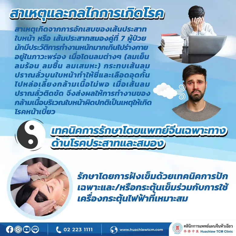 อัมพาตใบหน้ารักษาได้ด้วยการฝังเข็ม โดย คลินิกการแพทย์แผนจีนหัวเฉียว