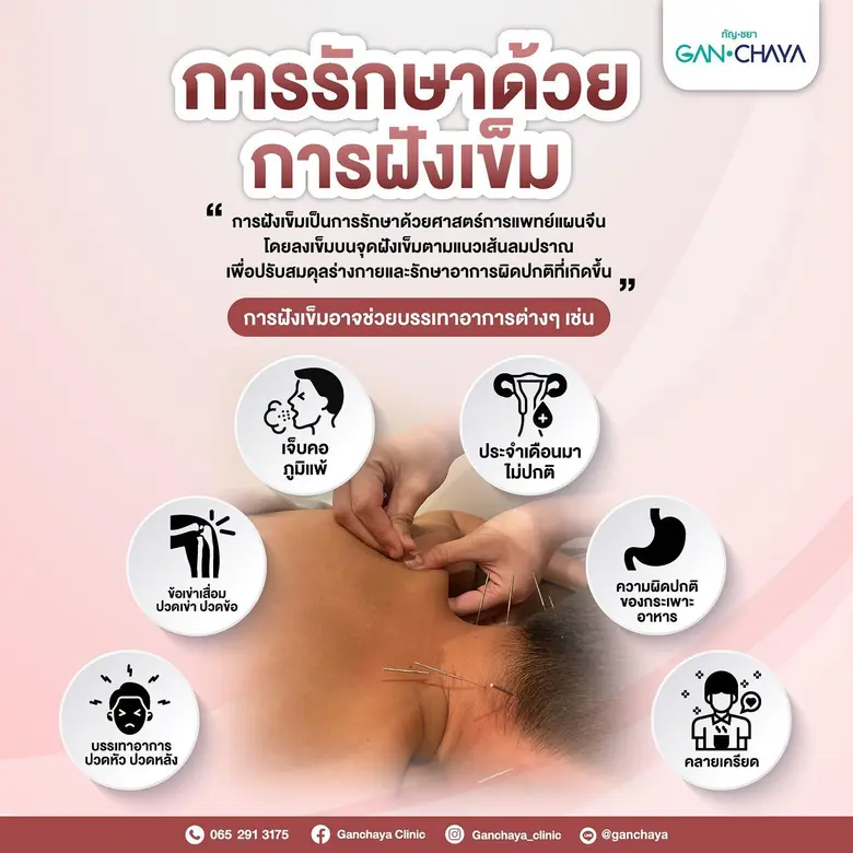 กัญชยา สหคลินิก ในเครือ บริษัท ทีเอชซีจี กรุ๊ป จำกัด เปิดตัว หัตถการจากศาตร์แห่งแพทย์แผนจีนเข้ามาเป็นอีกหนึ่งทางเลือกให้กับผู้ที่มีปัญหาด้านสุขภาพ