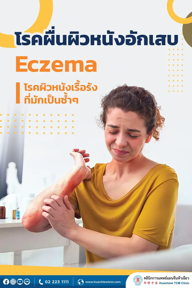 โรคผื่นแพ้อักเสบ หรือที่เรียกว่า Eczema พ...
