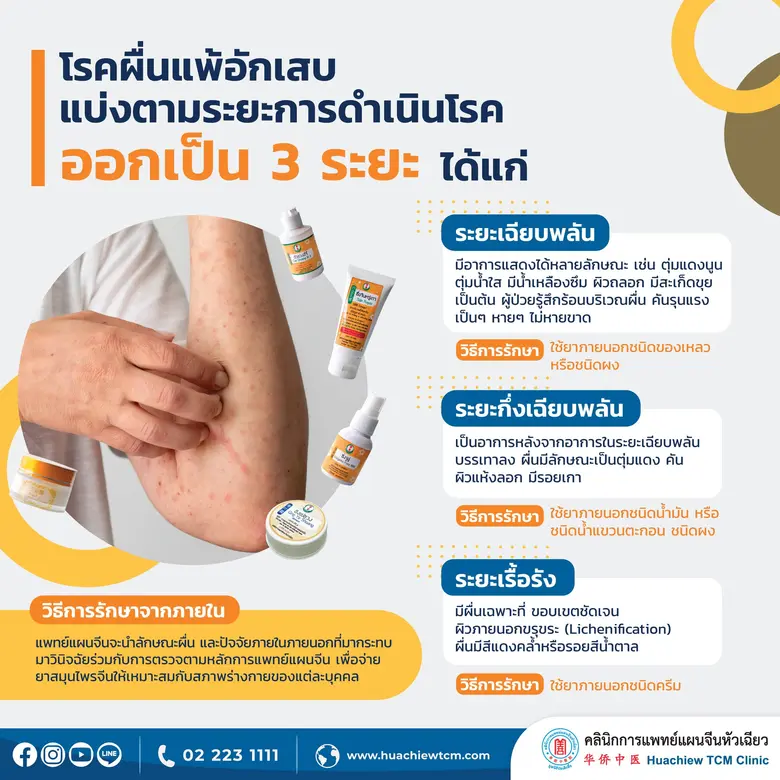โรคผื่นผิวหนังอักเสบ (Eczema) ป้องกันและรักษาได้ด้วยการแพทย์แผนจีน โดย คลินิกการแพทย์แผนจีนหัวเฉียว