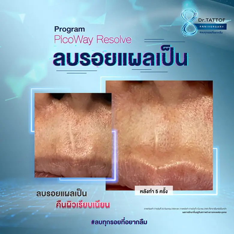 Dr.TATTOF ดันเทคโนโลยีเลเซอร์ลบรอยแผลเป็น ชูความเป็นศูนย์เลเซอร์ครบวงจร