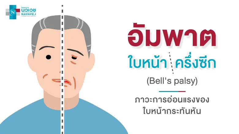 อัมพาตใบหน้าครึ่งซีก (Bell's palsy) เป็นภ...