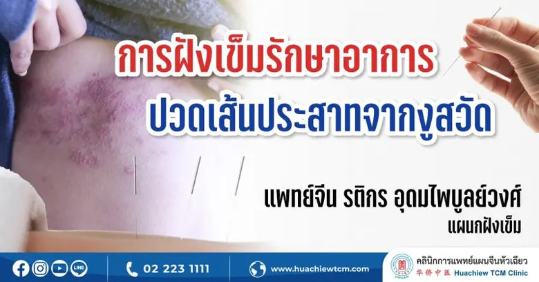 งูสวัด เป็นโรคผิวหนังที่เกิดจากการติดเชื้...