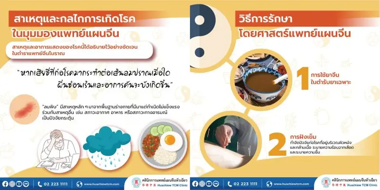 ลมพิษ ผื่นลม ผื่นซ่อนเร้น โรคผิวหนังเรื้อรังที่เป็นซ้ำแล้วซ้ำอีก โดย คลินิกการแพทย์แผนจีนหัวเฉียว