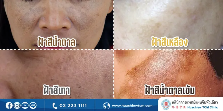 หมอจีนไขความลับ "สีฝ้าบ่งบอกโรค" โดย คลินิกการแพทย์แผนจีนหัวเฉียว