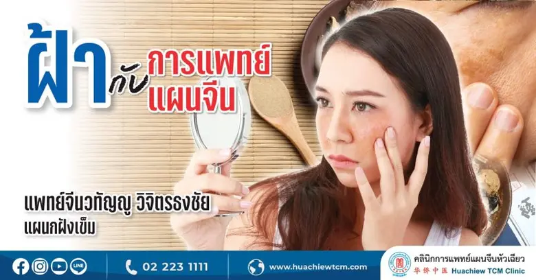 ฝ้า คือ เซลล์ผิวสร้างเม็ดสีใต้ผิวหนังทำงา...