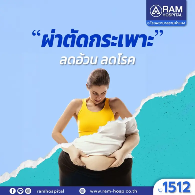 "ผ่าตัดกระเพาะ"... ลดอ้วน ลดโรค"อ้วนแล้วไ...