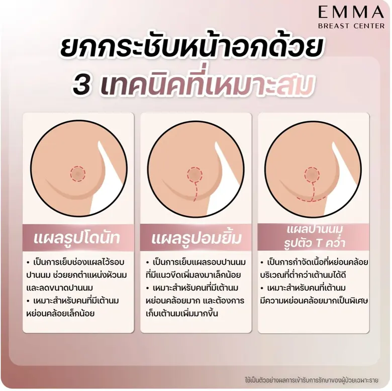 เสริมหน้าอกที่ไหนดี เจาะลึกเทคนิคยกกระชับหน้าอกสไตล์ EMMA