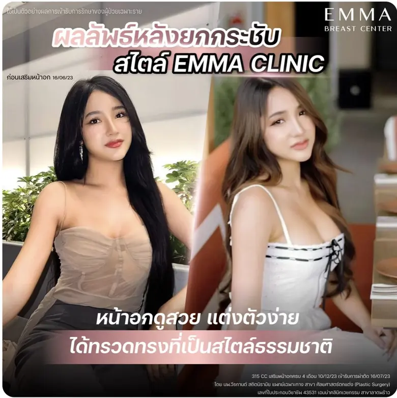 เสริมหน้าอกที่ไหนดี เจาะลึกเทคนิคยกกระชับหน้าอกสไตล์ EMMA