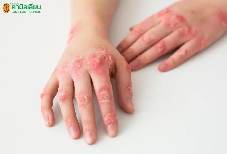 "โรคงูสวัด" เกิดจากการติดเชื้อวาริเซลลา ซอสเตอร์ไวร...